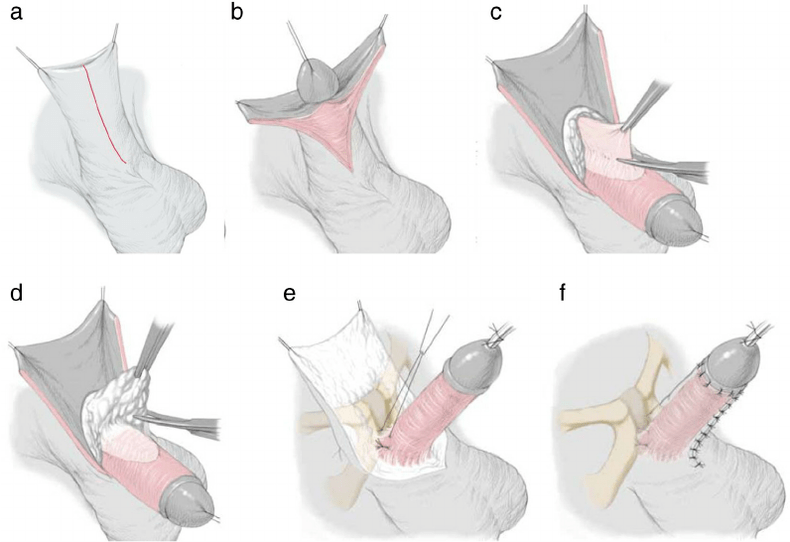 ligamentotomy for penis enlargement