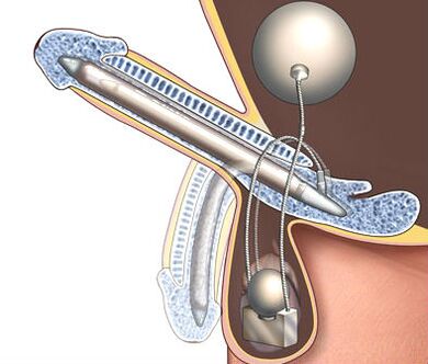 penile prosthesis for enlargement
